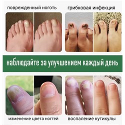 Крем для лечения грибка ногтей 30гр