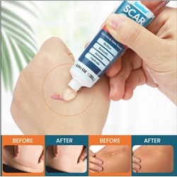 Гель от шрамов и рубцов 30г