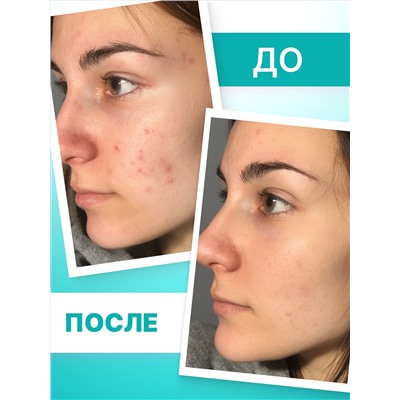Крем локального действия для проблемной кожи TeenSkin