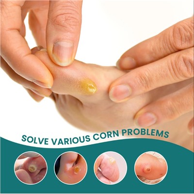 Пластырь для удаления стержневых мазолей на ногах, в упаковке24 шт