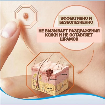 Крем для удаления бородавок, родинок и папиллом, 20 г