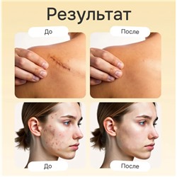 Крем от шрамов и рубцов, постакне, растяжек с маслом змеи 20гр