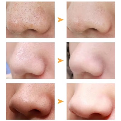 Очищающие полоски для носа, Набор 10 штук.