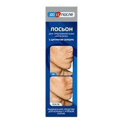 Лосьон «До и После» Анти-Акне для проблемной кожи, 200 мл