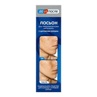 Лосьон «До и После» Анти-Акне для проблемной кожи, 200 мл