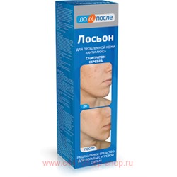 До и после Анти-Акне лосьон для проблемной кожи 200мл
