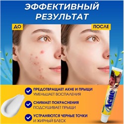 Крем от акне ,прыщей ,дерматита 30г